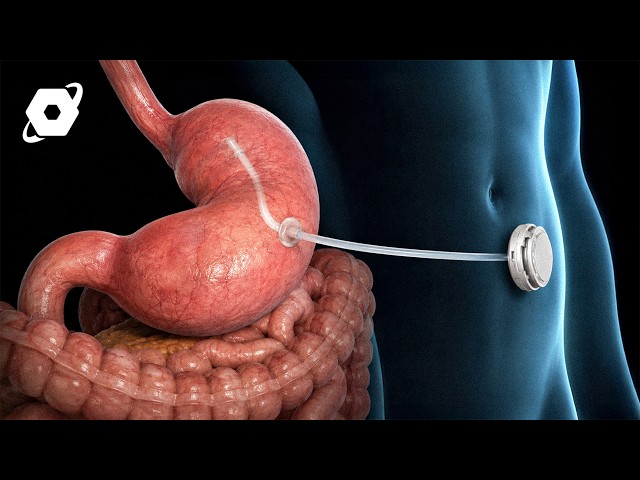 The $5,000 Device That Drains Your Stomach After Eating